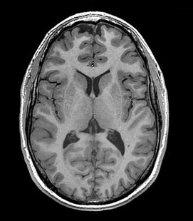 View of the brain from above, courtesy of an MRI scanner